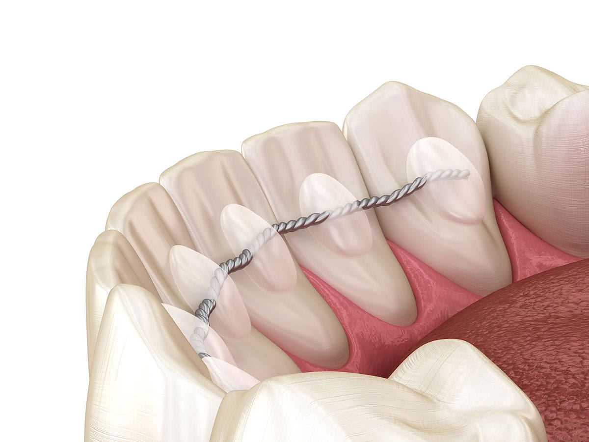 Illustration eines festen Retainer-Drahts hinter den Zähnen.